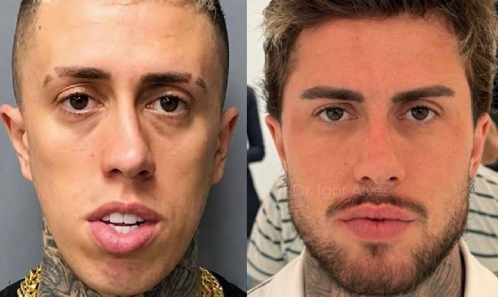 Antes e depois de MC Daniel após procedimentos estéticos impressiona a web: 'Salvou a vida dele'; veja