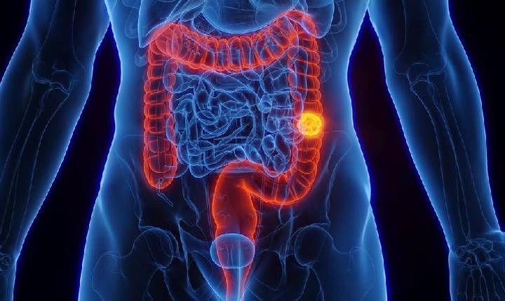 Câncer de intestino: brasileiros reconhecem sinais de alerta, mas não buscam atendimento