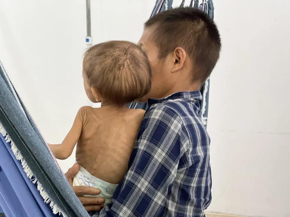 Crianças Yanomami desnutridas chegam 'pequenas, emagrecidas, caquéticas e de cabelo ralo', diz pediatra