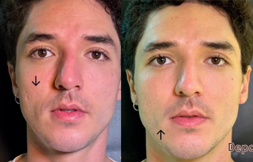 Namorado de Iza e ator de 'O agente secreto' passa por tratamento facial: 'Deixar mais bonito'