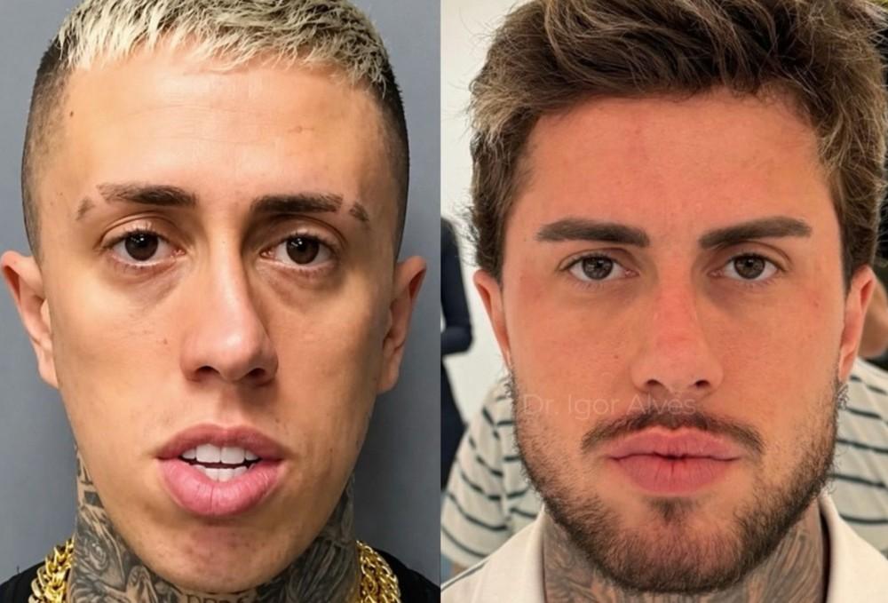 Antes e depois de MC Daniel após procedimentos estéticos impressiona a web: 'Salvou a vida dele'; veja