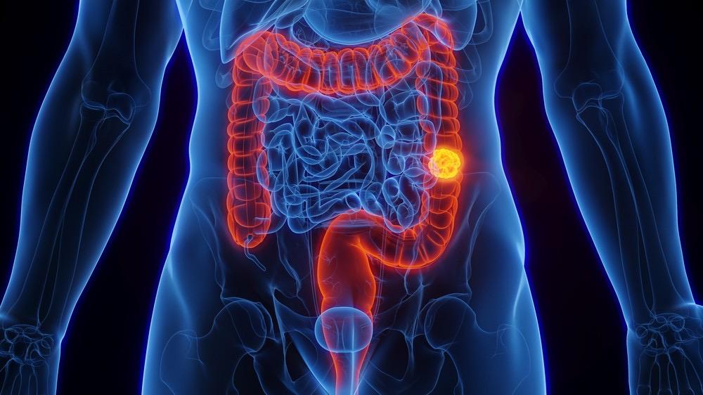 Câncer de intestino: brasileiros reconhecem sinais de alerta, mas não buscam atendimento